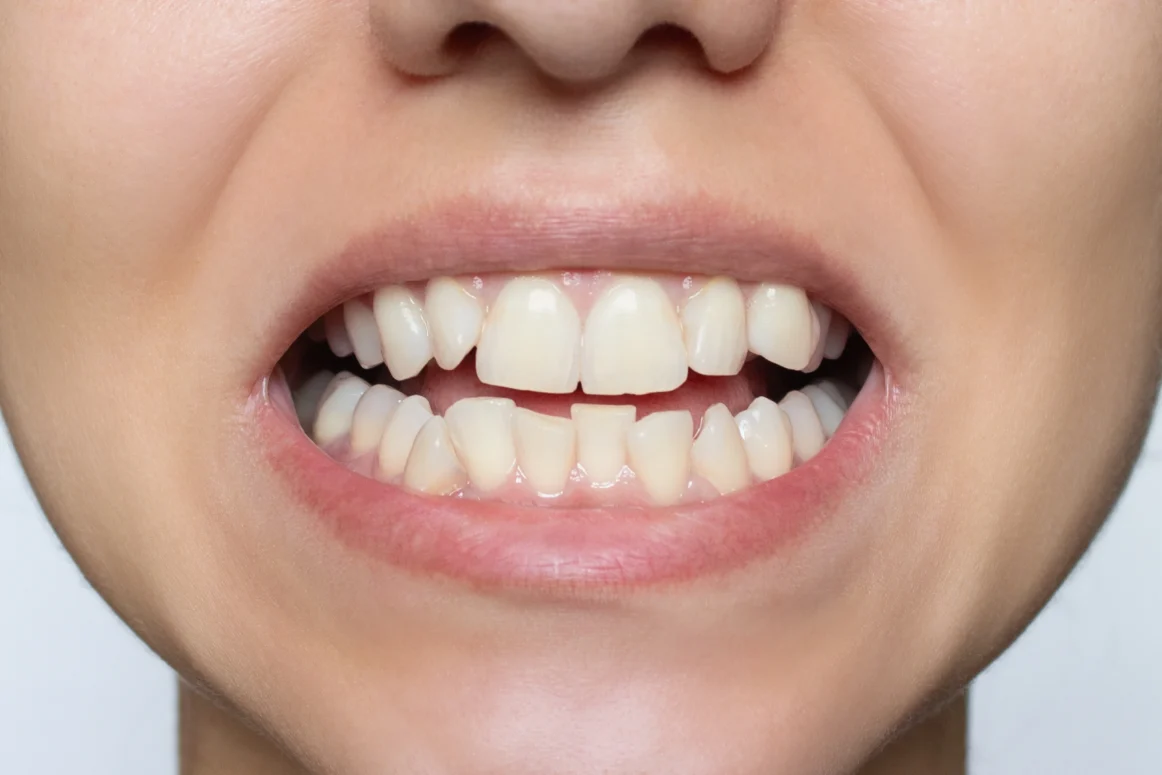 Treatment for crowded teeth