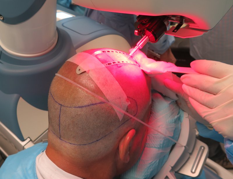 What Benefits Come with Robotic Hair Transplant