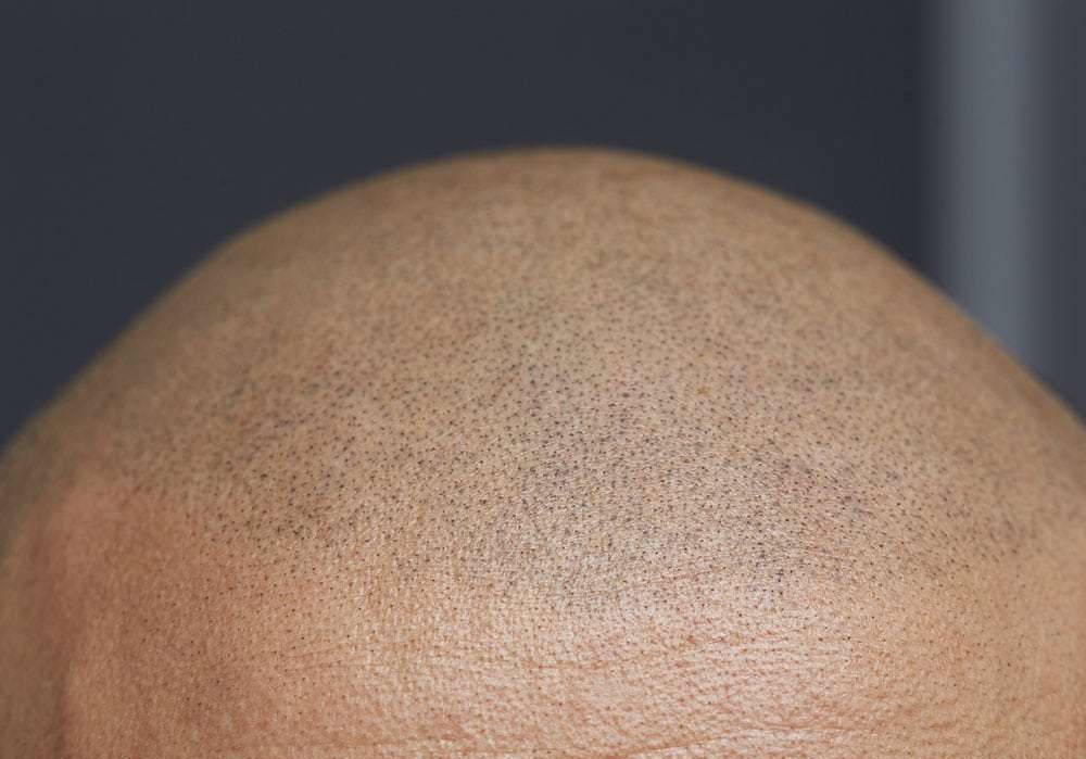 What Is the Process of Scalp Micropigmentation