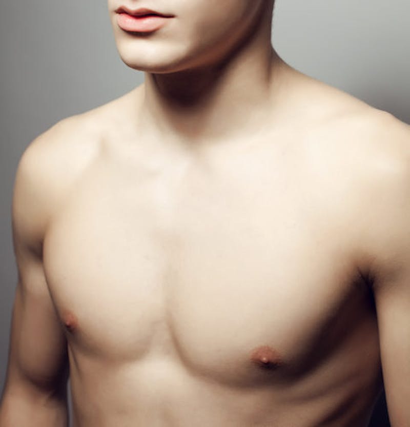 What to Expect After Gynecomastia Surgery Recovery and Results Timeline