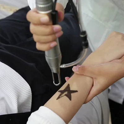 Why Laser Tattoo Removal Is the Safest Way to Erase Regret