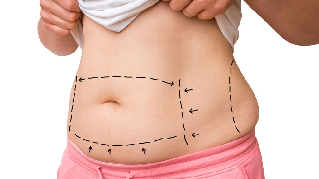 Why Liposuction Is Ideal for Stubborn Belly Fat ?