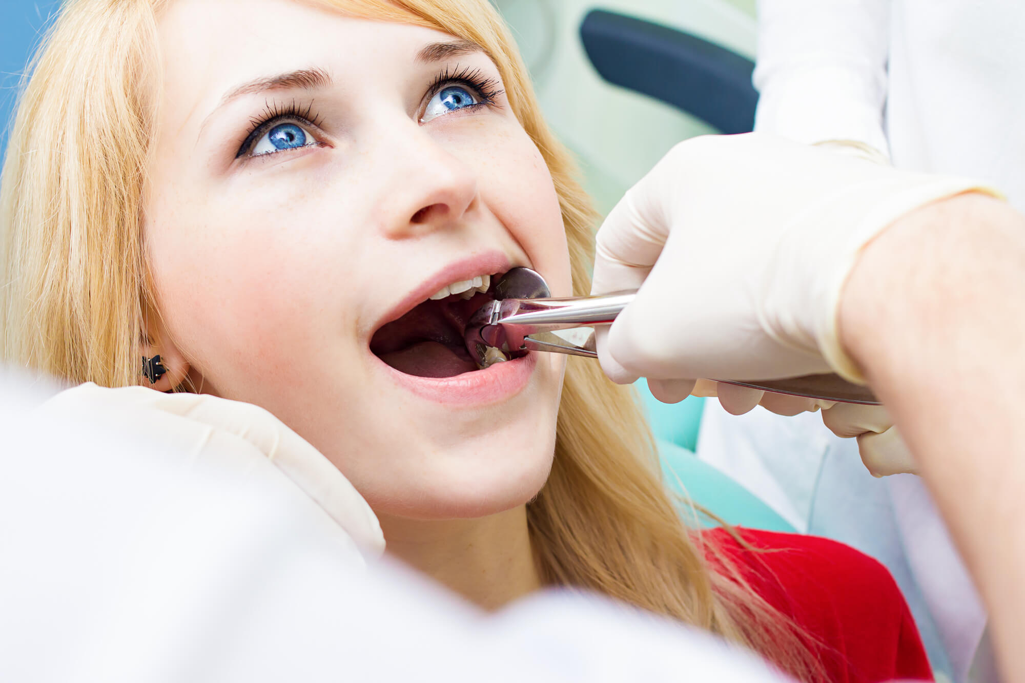 Wisdom Tooth Extraction cost
