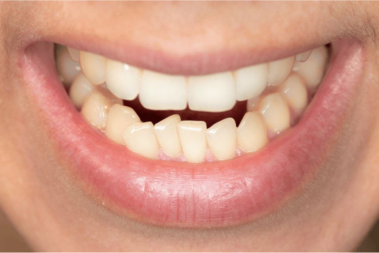 crowded teeth treatment without braces