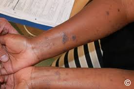 Understanding Hypertrophic Lichen Planus: A Complete Patient Guide