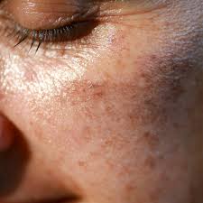 Why Do Skincare Experts Recommend Triple Skin Formula – Pigmanorm for Pigmentation?: