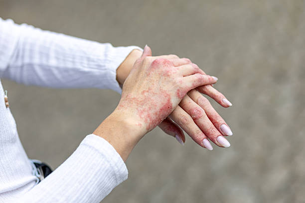 Can Eczema Treatment Improve Skin Confidence?