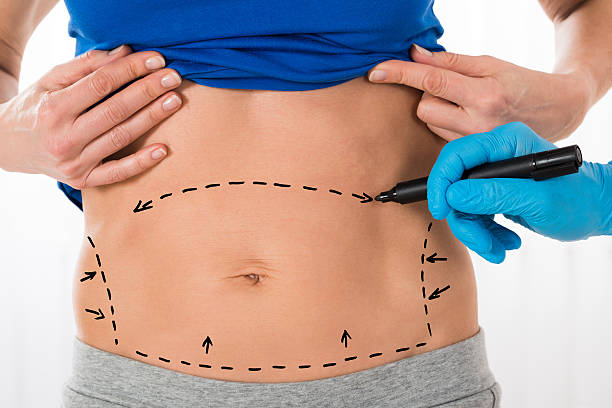 Can Tummy Tuck Improve Core Strength and Stability?