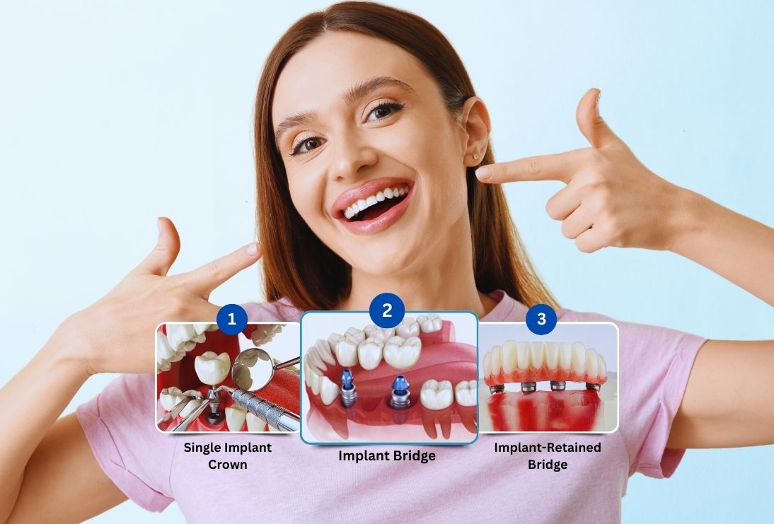 Dental Implants Dubai & Abu Dhabi