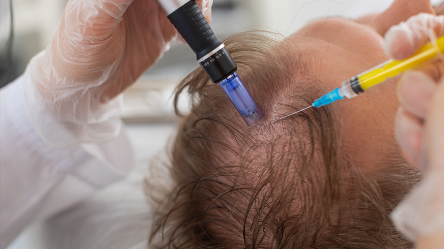 Exosome Therapy for Hair Loss and Regrowth