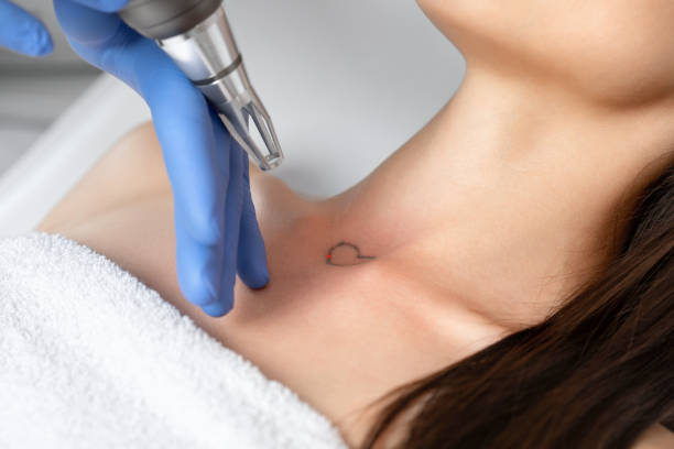 How Laser Tattoo Removal Restores Skin Confidence How Laser Tattoo Removal Restores Skin Confidence