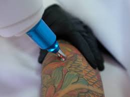 How Laser Tattoo Removal Works The Science Behind the Fade How Laser Tattoo Removal Works The Science Behind the Fade