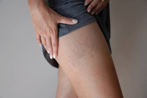 How Varicose Veins Treatment Restores Natural Beauty ?