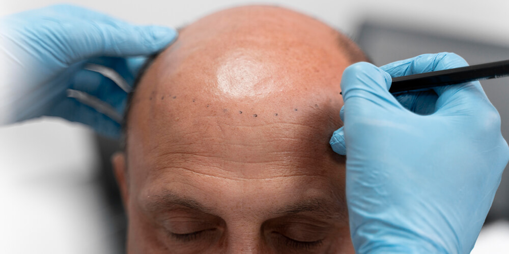 Hybrid Hair Transplant for a Youthful Appearance