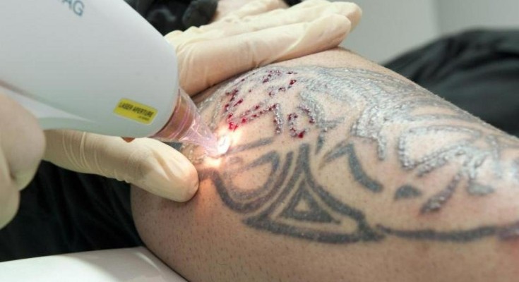 Is Laser Tattoo Removal Abu Dhabi Permanent