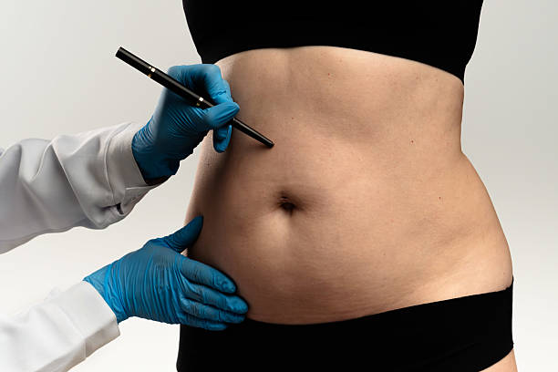 Is Liposuction Surgery the Right Option for You Is Liposuction Surgery the Right Option for You