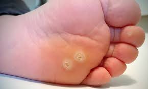 Why Do Dermatologists Recommend Warts Removal for Spotless Skin?