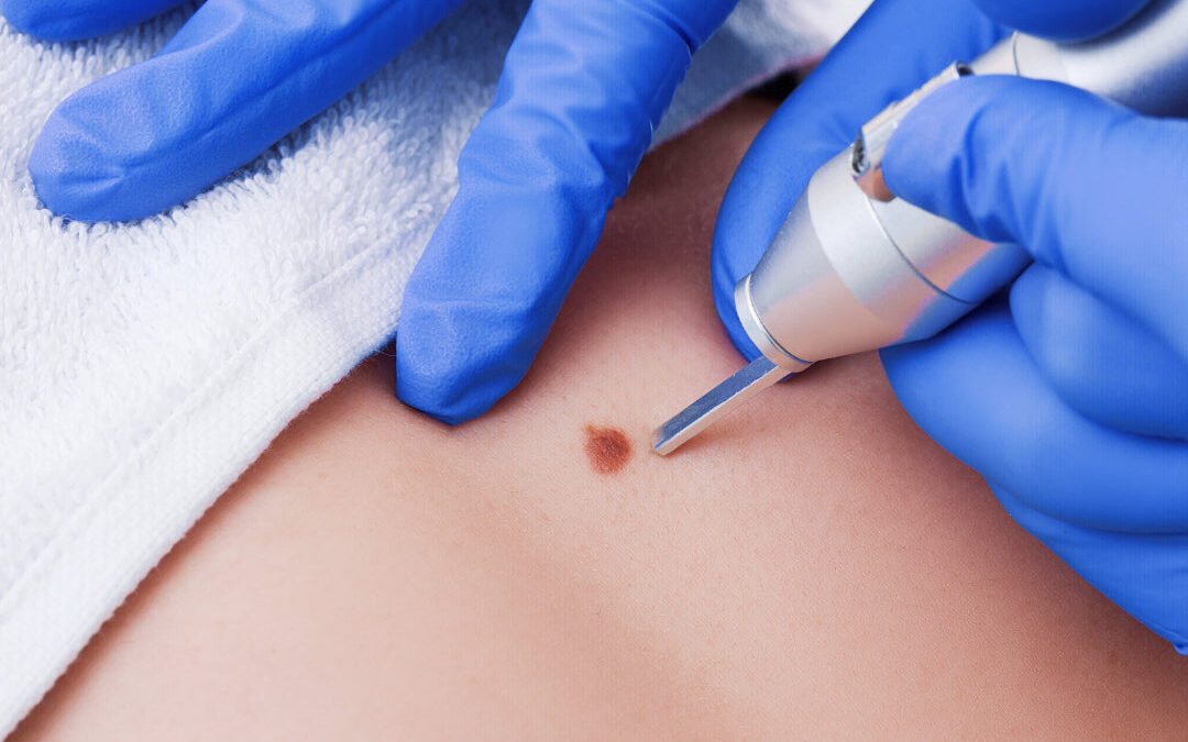 Why Are Clinic-Based Warts Removal Procedures Highly Recommended?: