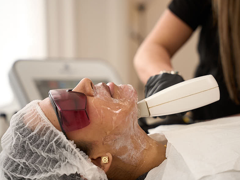 Fractional Laser Treatment in London: Repairing Damaged Skin with Precision