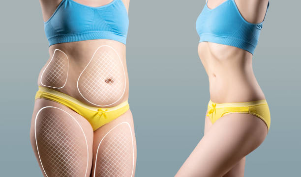 Liposuction procedure in Riyadh