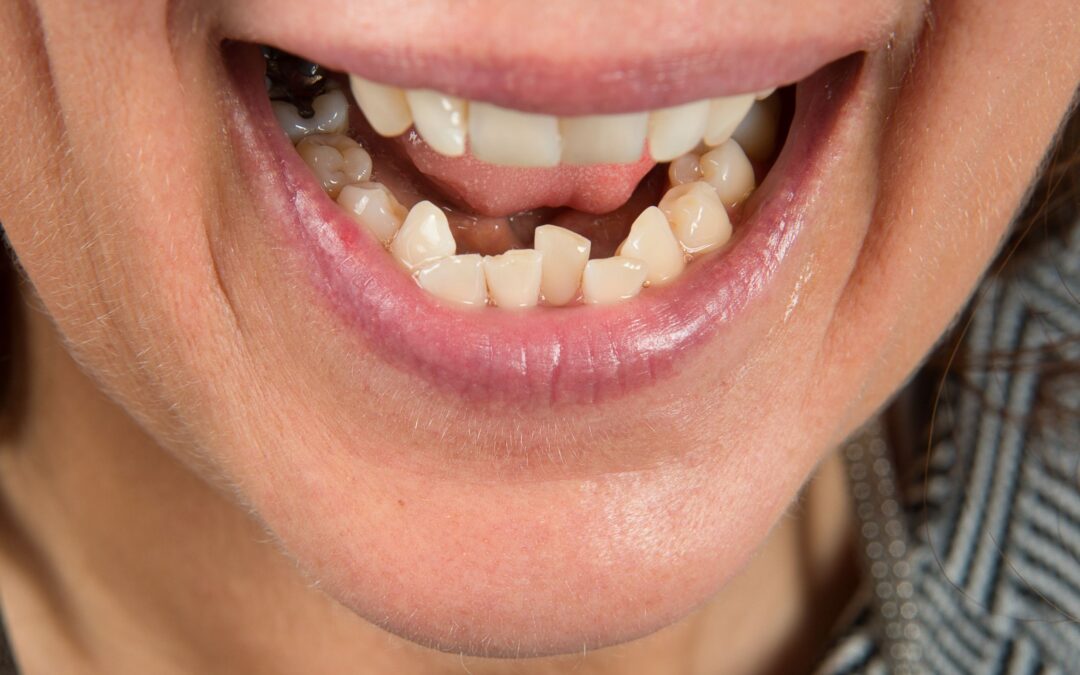 Can Cosmetic Dentistry Help Fix Mild Crowding?