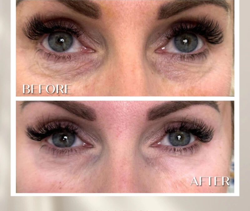 Under-Eye Rejuvenation with Polynucleotides in Manchester