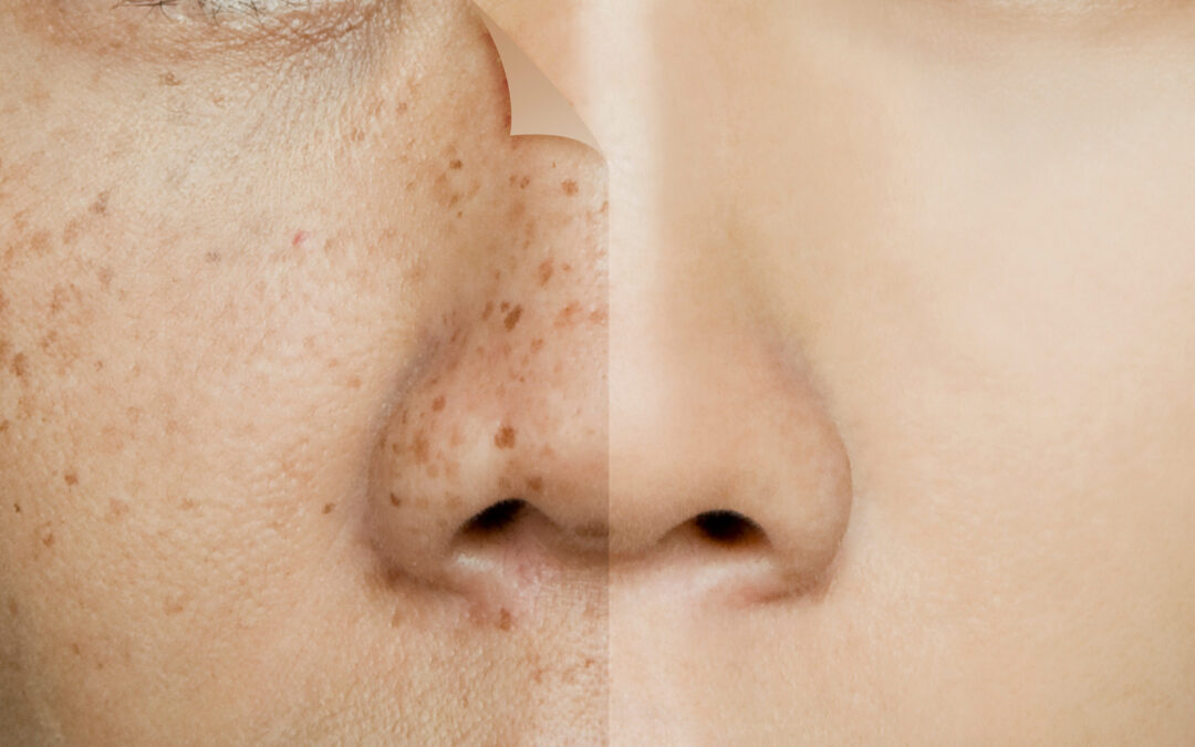 Lifestyle Adjustments to Support Dermal Pigmentation Healing in Riyadh