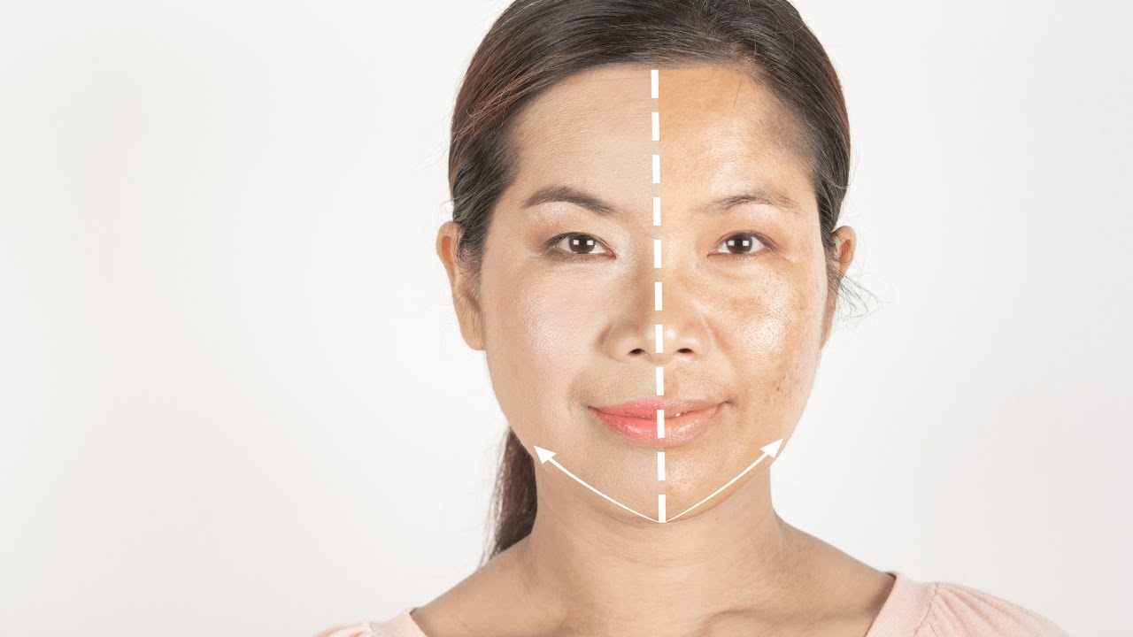 Skin Pigmentation Treatment in Riyadh Skin Pigmentation Treatment in Riyadh
