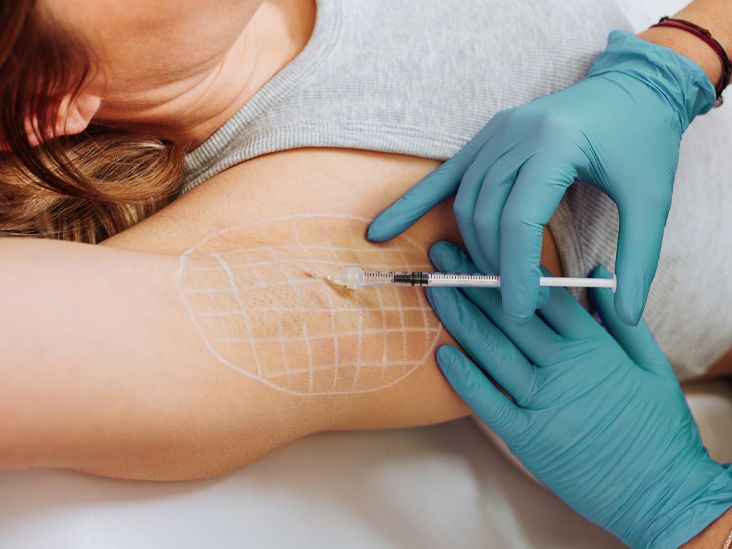 Targeted Botox Injections for Sweat Control