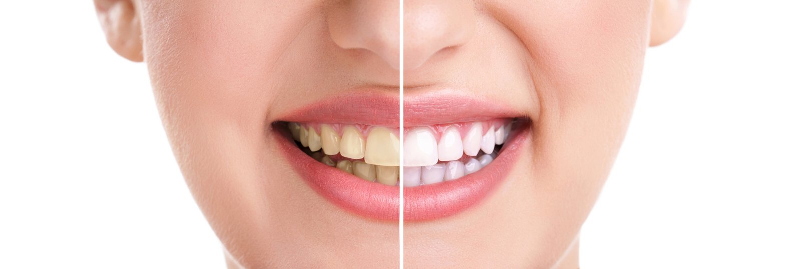 Teeth Whitening How It Really Works Teeth Whitening How It Really Works
