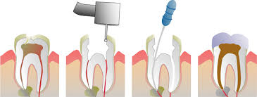 Tooth nerve treatment Dubai
