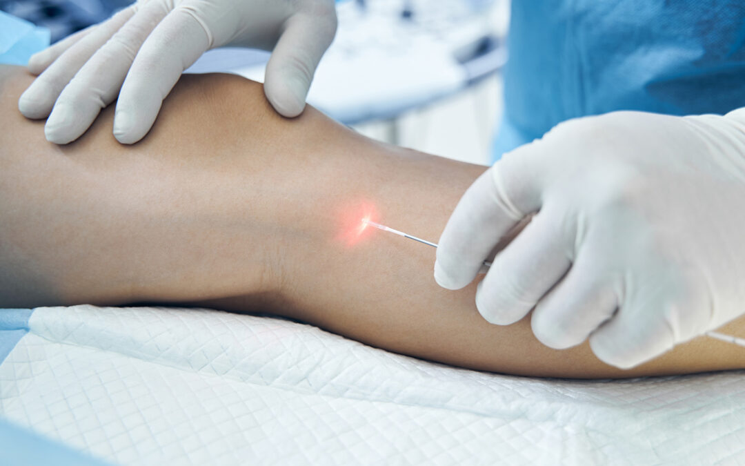 Transform Your Legs with Varicose Veins Treatment