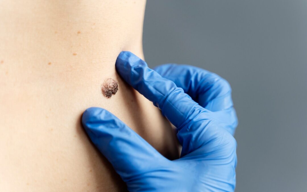 Warts Removal Treatment with Minimal Downtime
