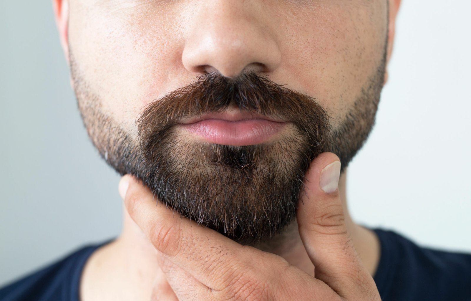 What Is the Recovery Time for Beard Hair Transplant What Is the Recovery Time for Beard Hair Transplant