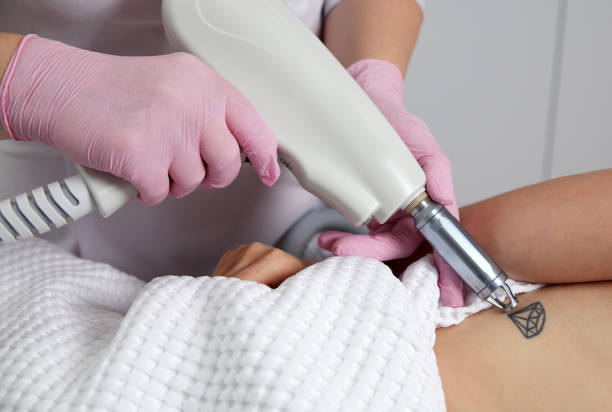 What to Expect from Your First PicoSure Tattoo Removal ?