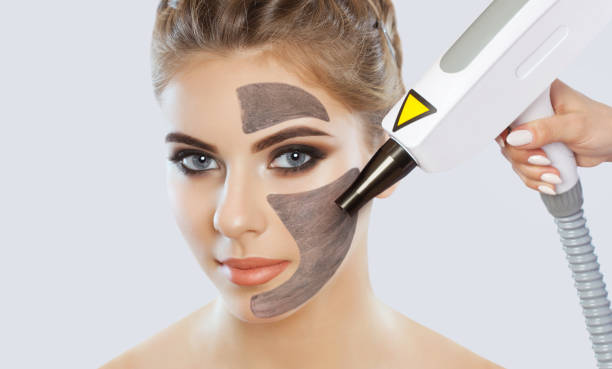 Why People Love Laser Carbon Peel for Glow Why People Love Laser Carbon Peel for Glow