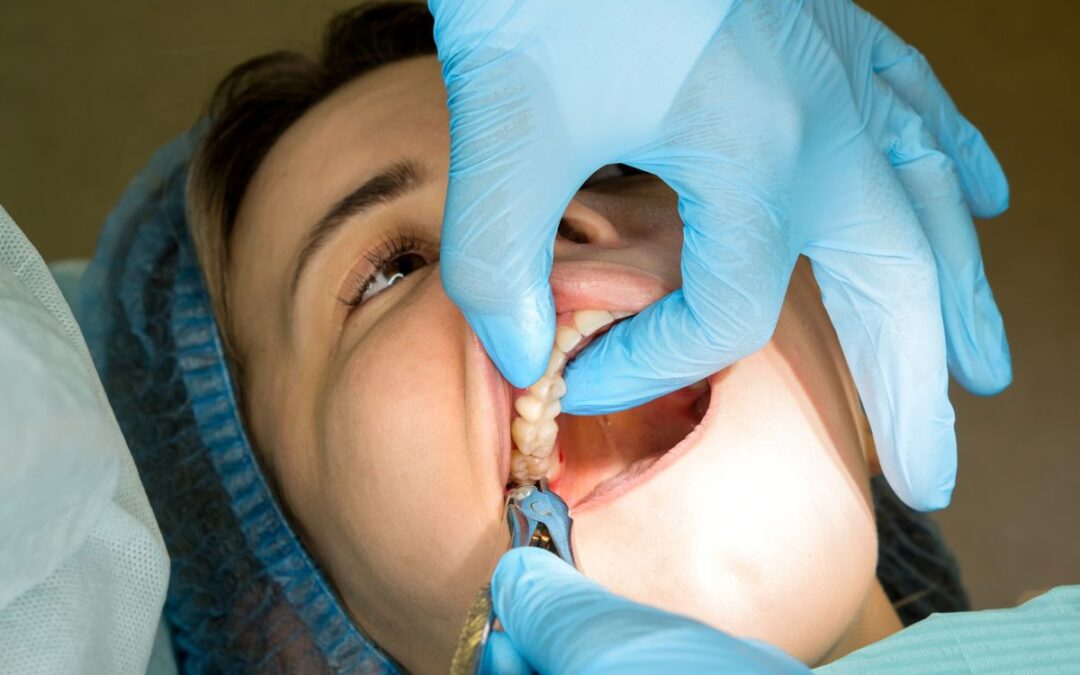 Differences Between Simple and Surgical Wisdom Tooth Extraction