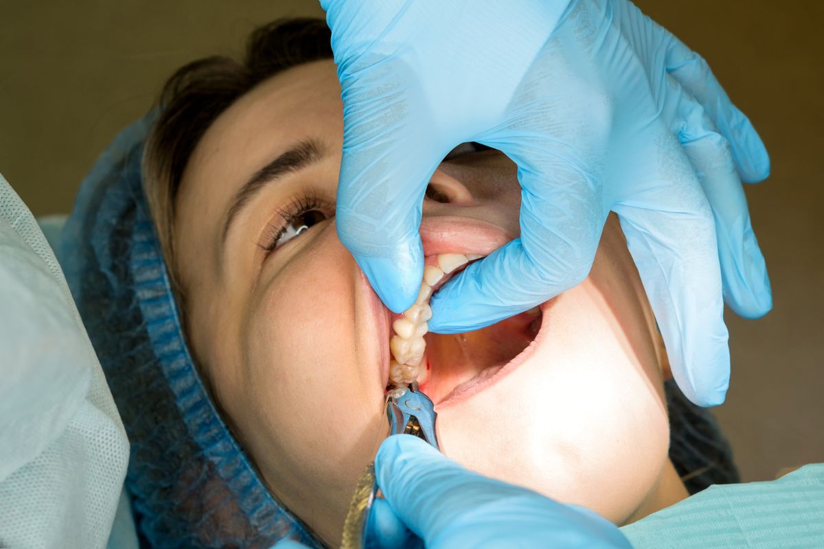 Wisdom Tooth Extraction in Dubai Wisdom Tooth Extraction in Dubai