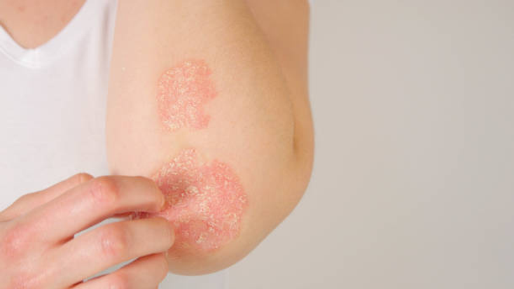 How Dermatologists Personalize Eczema Treatment for Better Results: