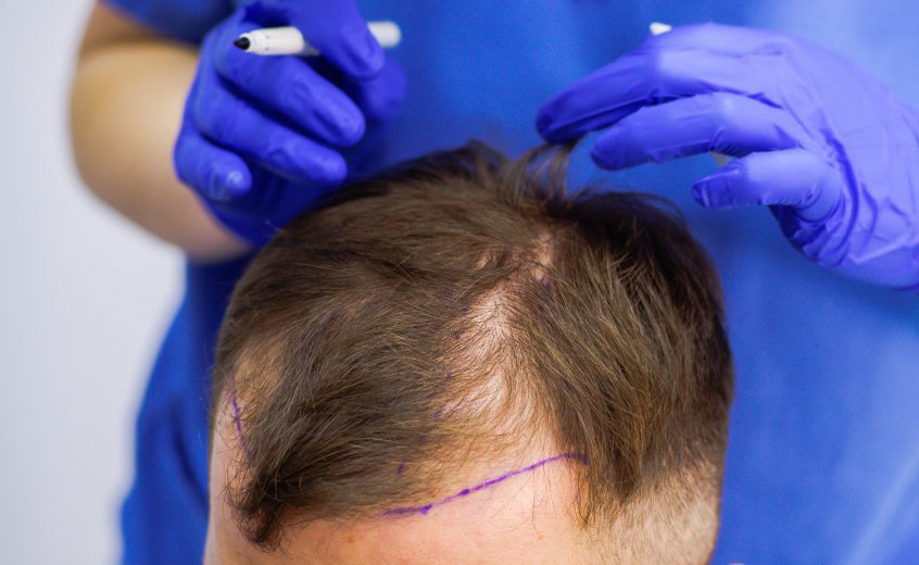 مراحل زراعة الشعر في الرياض بالتفصيل من البداية حتى النتيجة